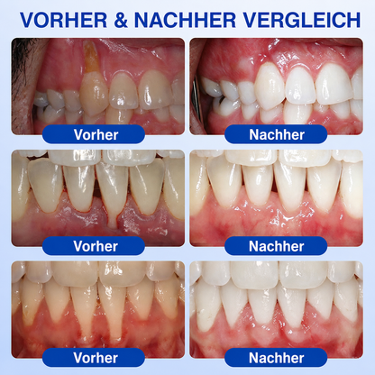 🦷🦢Healrize® GumRevive Gel zur Regeneration des Zahnhalteapparats (bei Zahnfleischbluten, Zahnfleischrückgang und lockeren Zähnen)🦷