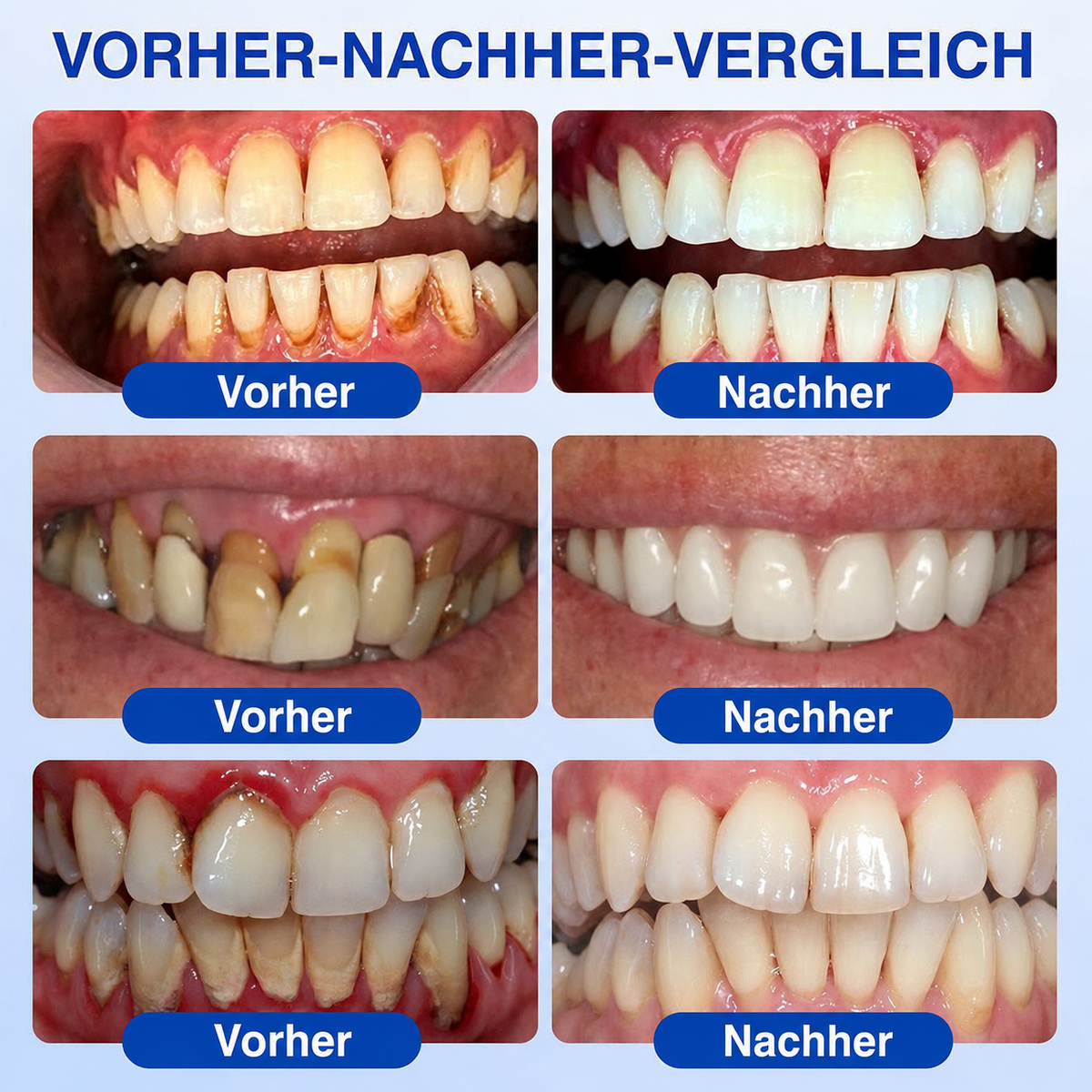 🦷🦢Healrize® GumRevive Gel zur Regeneration des Zahnhalteapparats (bei Zahnfleischbluten, Zahnfleischrückgang und lockeren Zähnen)🦷