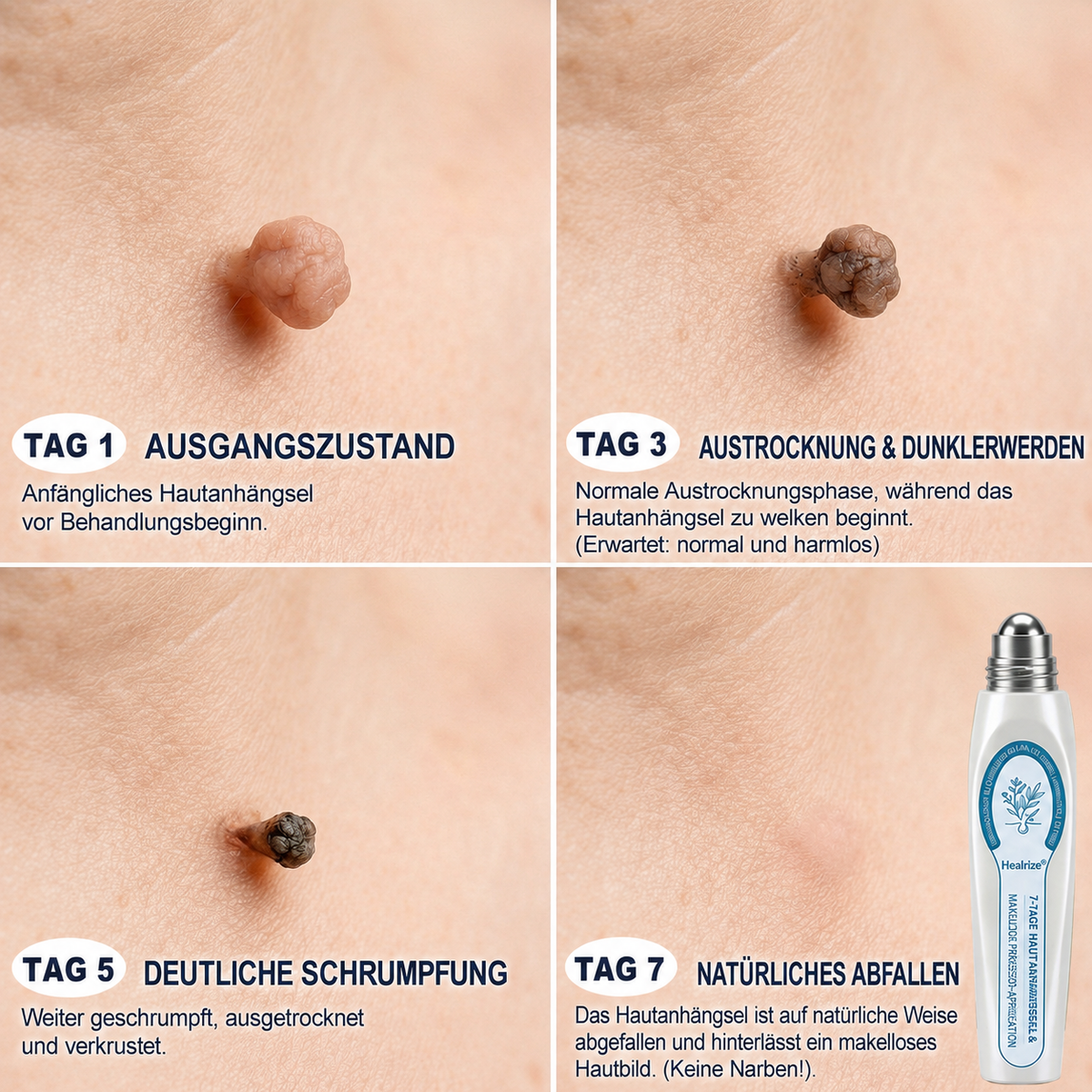 Healrize® 7-Tage Hautmal- & Flecken-Entferner 🐰(Schmerzfrei, Narbenfrei mit Rollball-Applikator)🐰